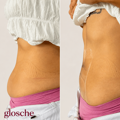 Glosche Lifting Tape — Legs, Tummy & Arms